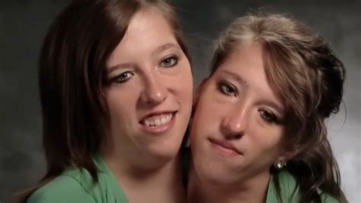 The Heartbreaking Story Of Abby And Brittany Hensel