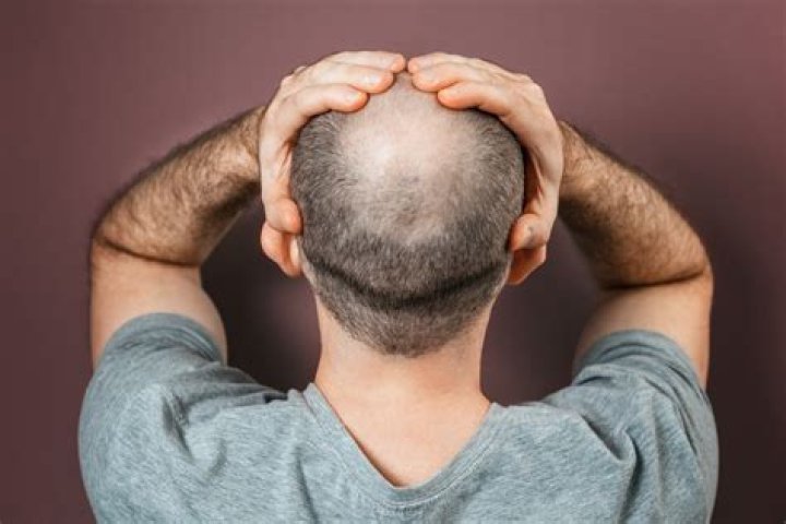 The Unfair Stigma Of Baldness: Breaking The 